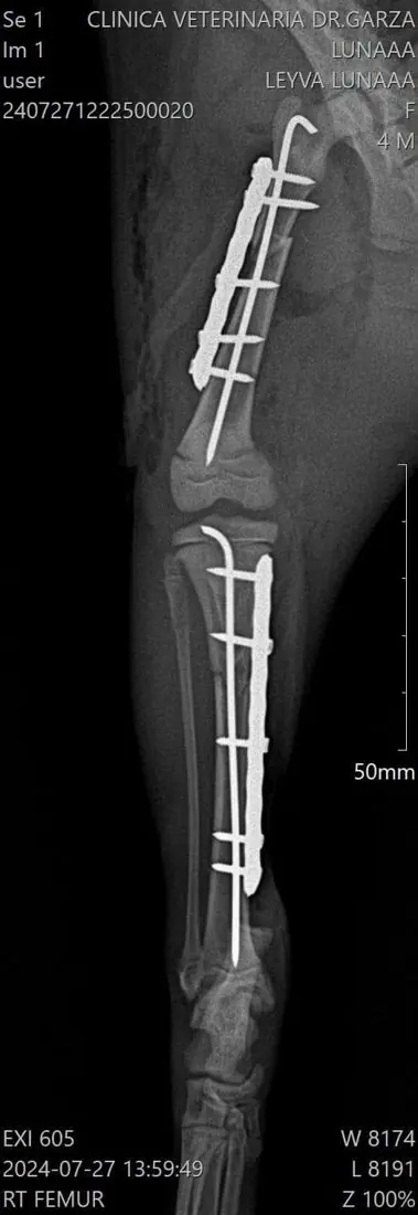 Radiografía de fémur con placas, cirugía hecha en la clínica
